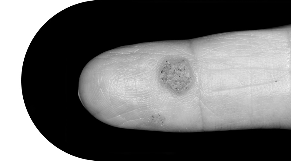 사마귀/티눈 치료대상
