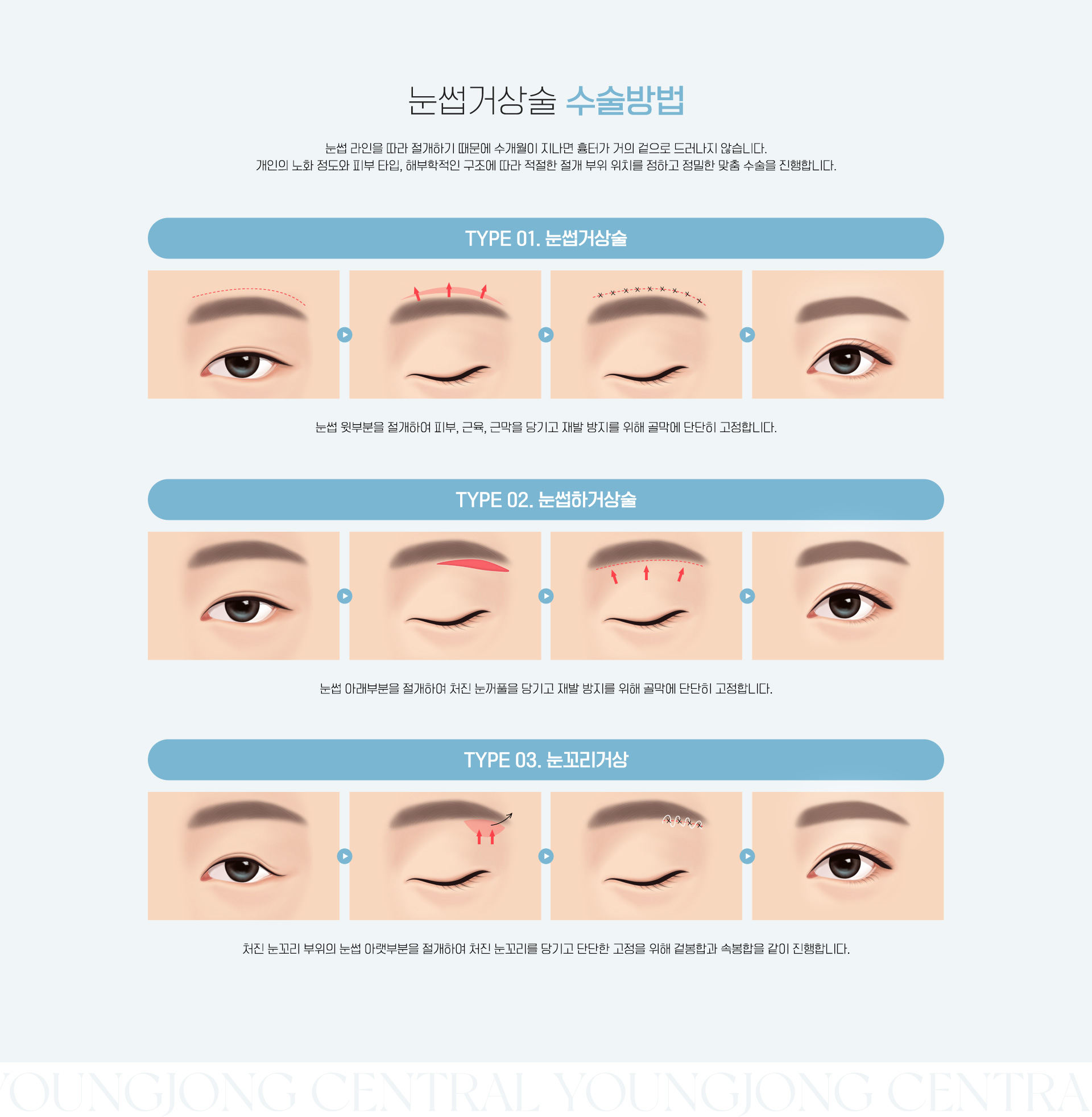 눈썹거상술 수술방법