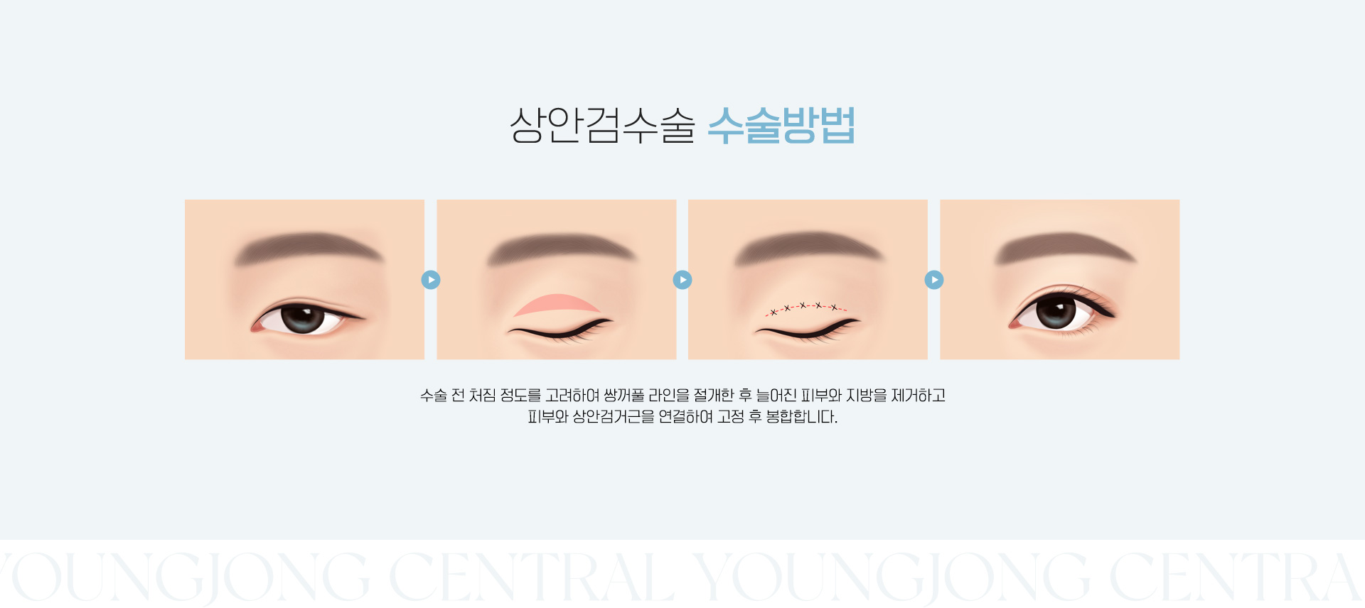 상안검수술 수술방법