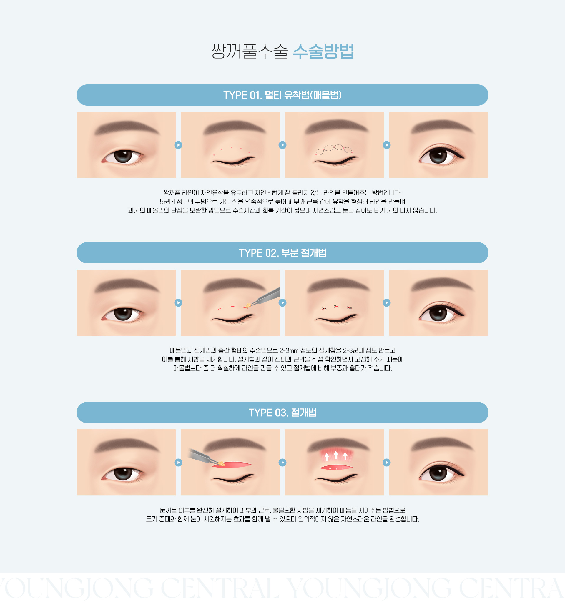 쌍꺼풀수술 수술방법