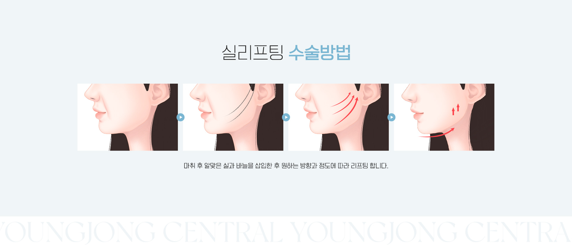 쌍꺼풀수술 수술방법