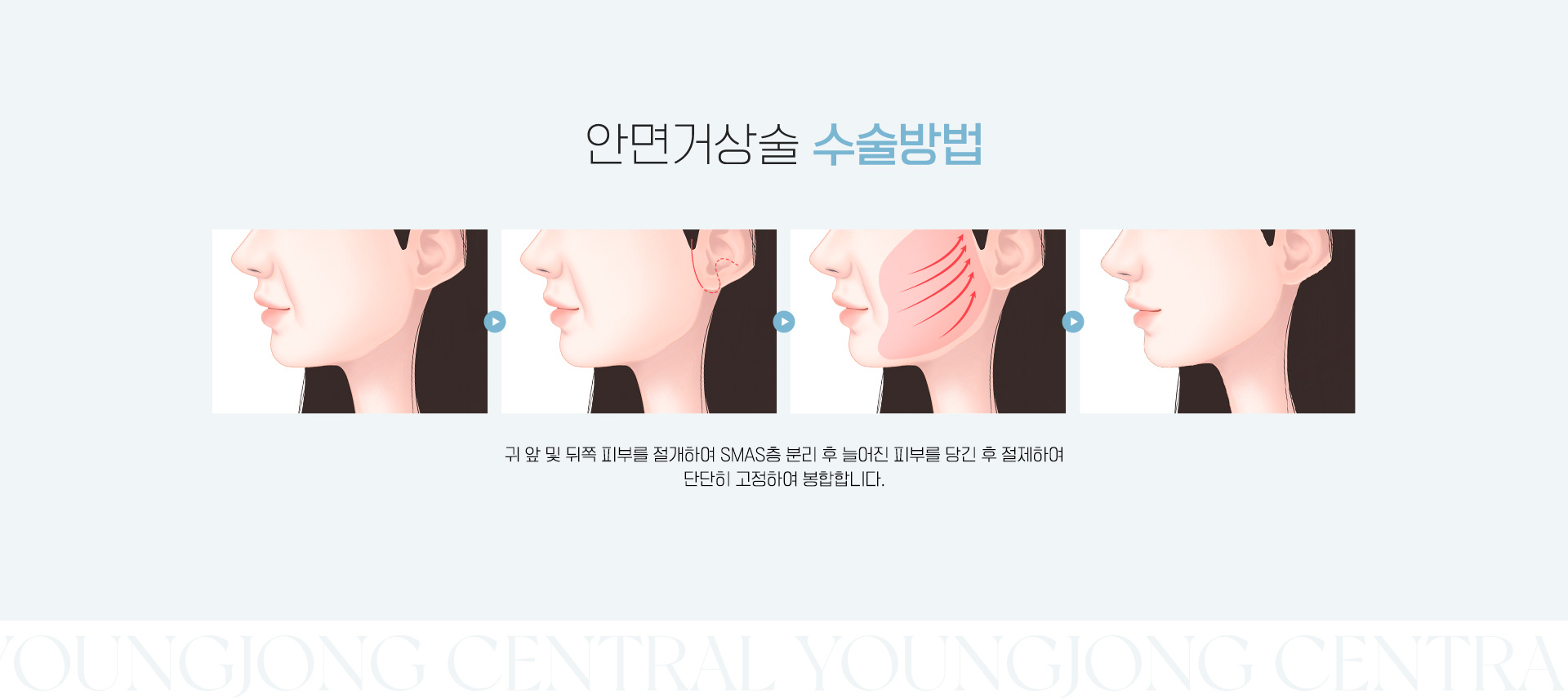 안면거상술 수술방법