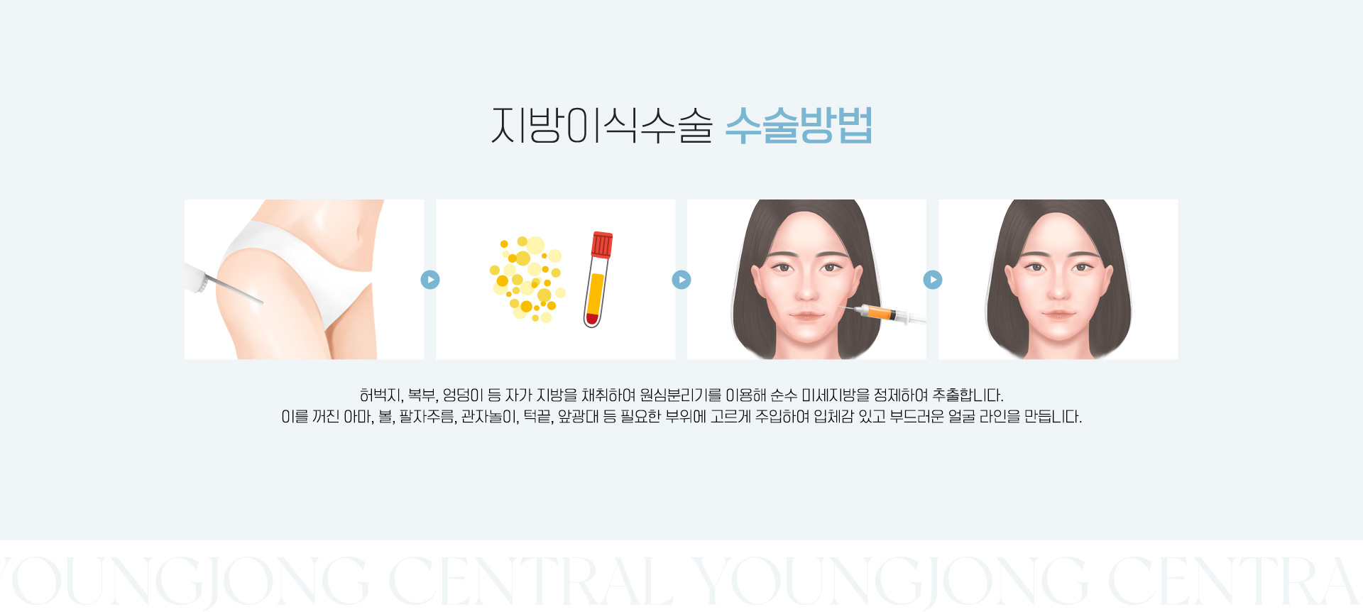 지방이식수술 수술방법