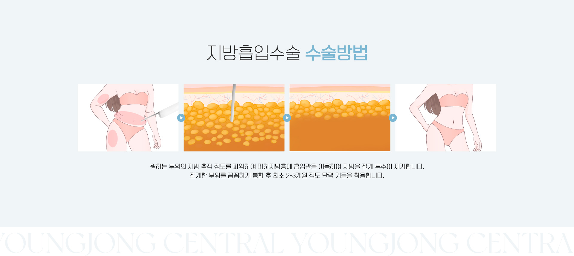 지방흡입수술 수술방법