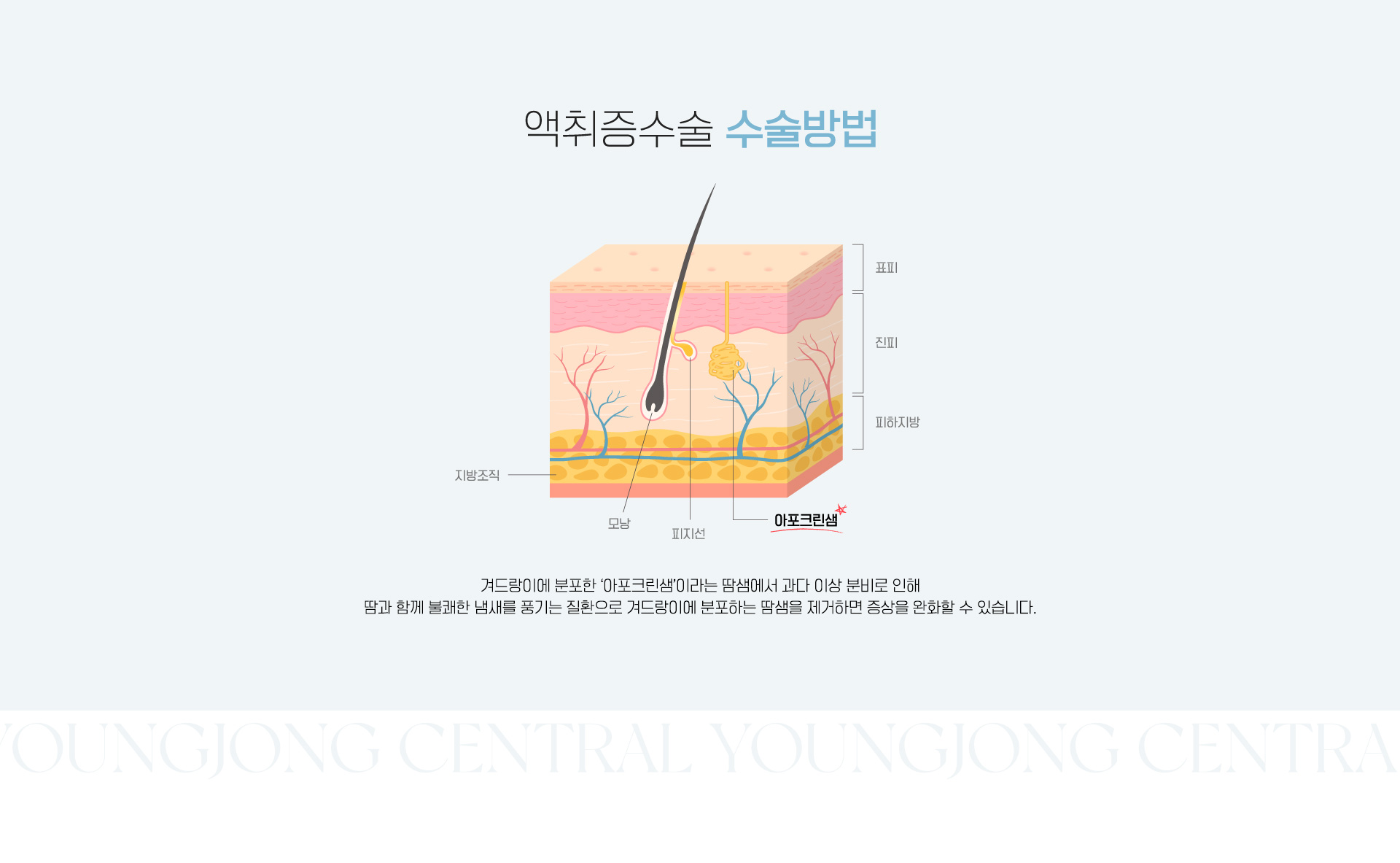 액취증수술 수술방법