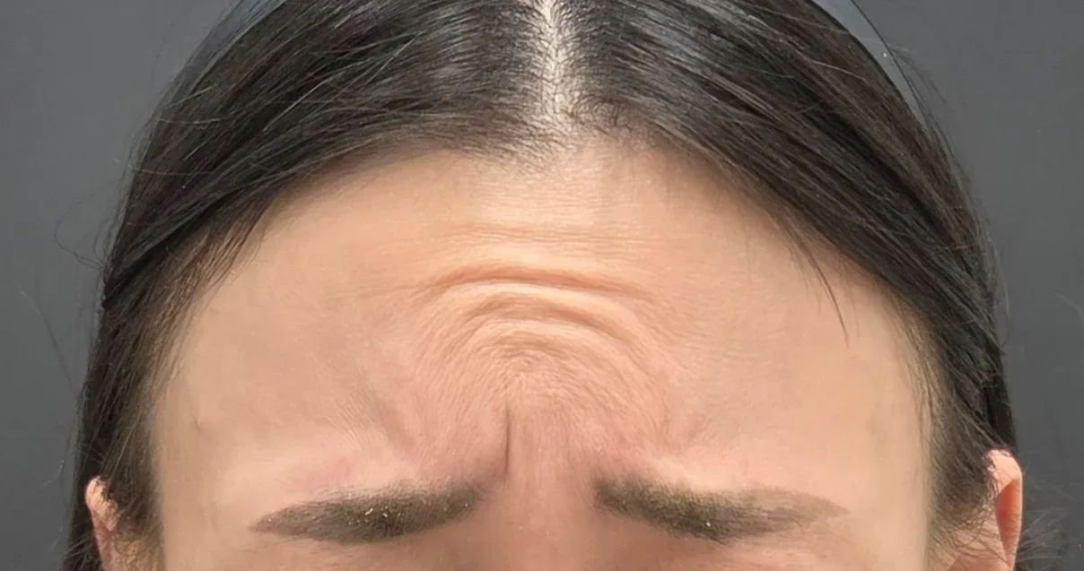Photo illustrating frown lines