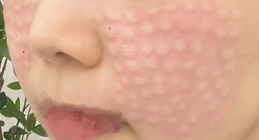 說明小丘疹與瘀青的照片