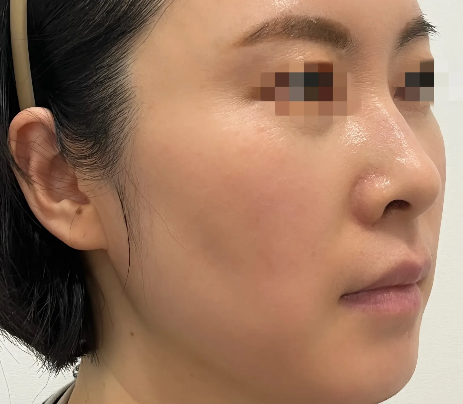 顯示臉頰凹陷位置的側面照片