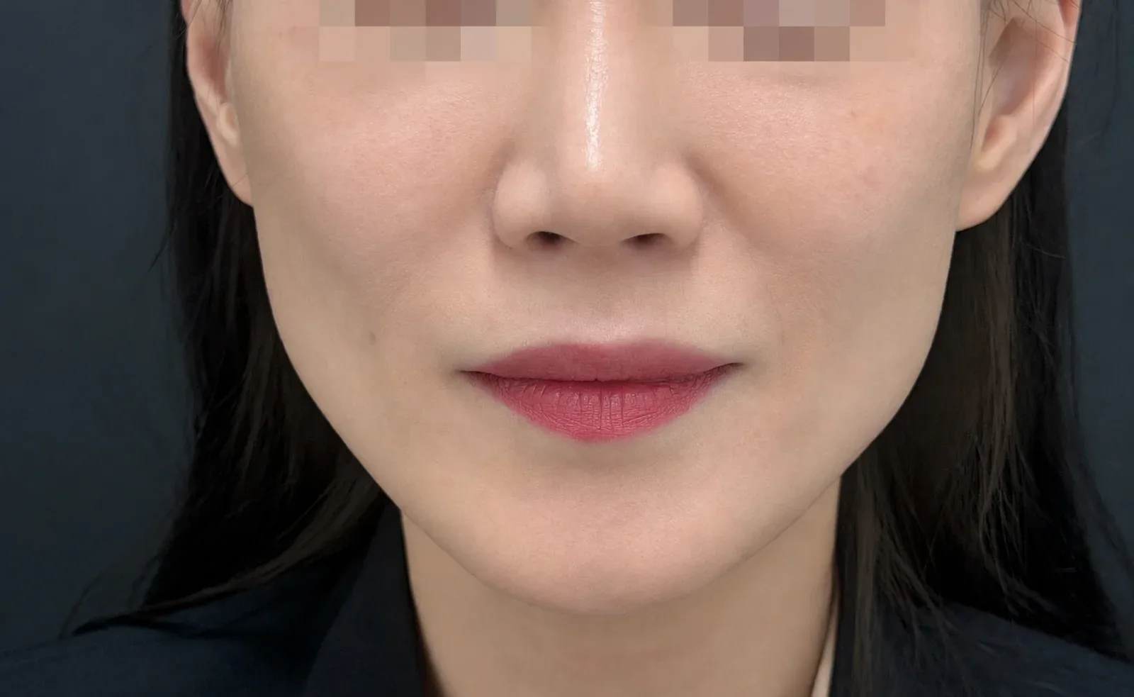 顯示臉頰凹陷位置的正面照片